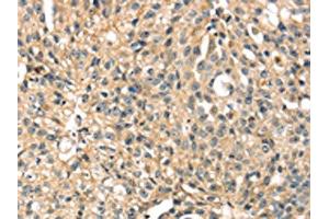 The image on the left is immunohistochemistry of paraffin-embedded Human breast cancer tissue using ABIN7131243(STX8 Antibody) at dilution 1/35, on the right is treated with fusion protein. (STX8 抗体)