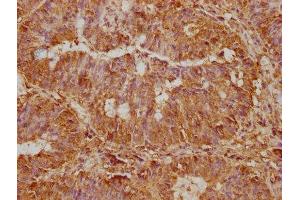 IHC image of ABIN7170987 diluted at 1:500 and staining in paraffin-embedded human colon cancer performed on a Leica BondTM system. (ST5 抗体  (AA 3-280))