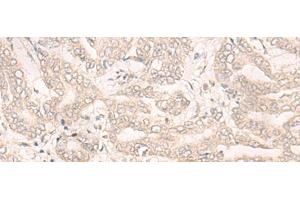 Immunohistochemistry of paraffin-embedded Human liver cancer tissue using ENO4 Polyclonal Antibody at dilution of 1:30(x200) (ENO4 抗体)