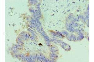 Immunohistochemistry of paraffin-embedded human colon cancer using ABIN7156372 at dilution of 1:100 (IGFBP4 抗体  (AA 22-258))