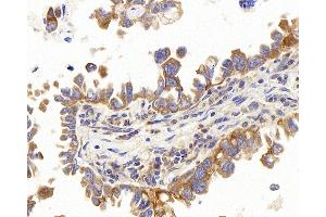 Immunohistochemistry analysis of paraffin-embedded human lung cancer using PERK Polyclonal Antibody at dilution of 1:400. (PERK 抗体)