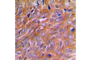 Immunohistochemical analysis of BNIP2 staining in human breast cancer formalin fixed paraffin embedded tissue section. (BNIP2 抗体  (Center))