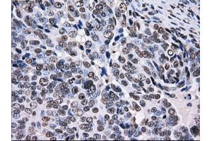Immunohistochemical staining of paraffin-embedded Adenocarcinoma of colon tissue using anti-RPA2 mouse monoclonal antibody. (RPA2 抗体)