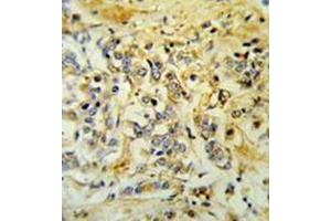 Immunohistochemistry analysis in formalin fixed and paraffin embedded breast carcinoma reacted with LMBR1L Antibody (C-term) followed which was peroxidase conjugated to the secondary antibody and followed by DAB staining. (LMBR1L 抗体  (C-Term))