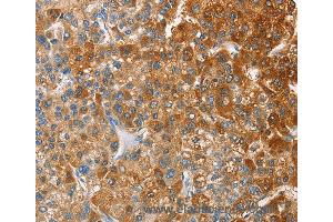 Immunohistochemistry of Human thyroid cancer using CD200R1 Polyclonal Antibody at dilution of 1:60