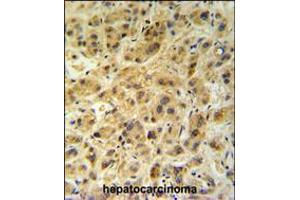GNS Antibody (Center N189) IHC analysis in formalin fixed and paraffin embedded human hepatocarcinoma followed by peroxidase conjugation of the secondary antibody and DAB staining. (GNS 抗体  (AA 174-203))