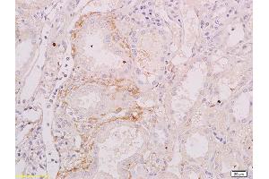 Formalin-fixed and paraffin embedded human renal carcinoma labeled with Anti-BAFFR/CD268 Polyclonal Antibody, Unconjugated (ABIN740760) at 1:200 followed by conjugation to the secondary antibody (TNFRSF13C 抗体  (AA 121-184))