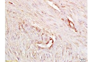 Formalin-fixed and paraffin embedded human endometrium carcinoma labeled with Anti P-cadherin Polyclonal Antibody, Unconjugated  at 1:200 followed by conjugation to the secondary antibody and DAB staining. (P-Cadherin 抗体  (AA 625-725))