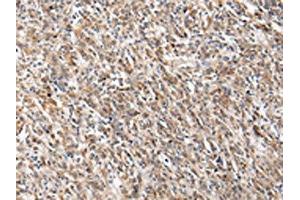 The image on the left is immunohistochemistry of paraffin-embedded Human gastric cancer tissue using ABIN7130604(PGRMC2 Antibody) at dilution 1/20, on the right is treated with fusion protein. (PGRMC2 抗体)