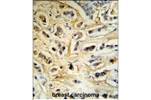 CASA Antibody (Center) (R) IHC analysis in formalin fixed and paraffin embedded human breast carcinoma tissue followed by peroxidase conjugation of the secondary antibody and DAB staining. (Casein alpha S1 抗体  (AA 42-70))