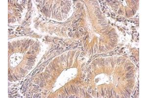 IHC-P Image RRM1 antibody detects RRM1 protein on human gastric cancer by immunohistochemical analysis. (RRM1 抗体  (Center))