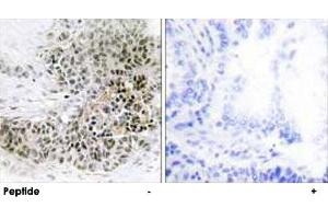 Immunohistochemistry analysis of paraffin-embedded human lung carcinoma tissue, using TRPS1 polyclonal antibody . (TRPS1 抗体  (AA 121-170))