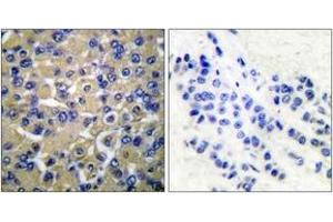 Immunohistochemistry analysis of paraffin-embedded human breast carcinoma tissue, using WNK1 (Ab-58) Antibody. (WNK1 抗体  (AA 24-73))