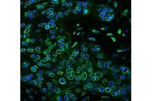 IF analysis of Emerin using anti-Emerin antibody (ABIN4886569) Emerin was detected in paraffin-embedded section of human oesophagus squama cancer tissues.
