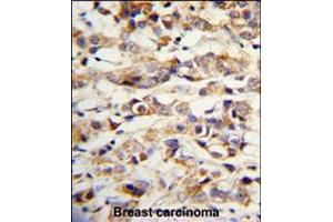 Formalin-fixed and paraffin-embedded human breast carcinoma with KRT14 Antibody , which was peroxidase-conjugated to the secondary antibody, followed by DAB staining.