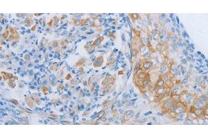 Immunohistochemistry of paraffin-embedded Human cervical cancer tissue using ADRB3 Polyclonal Antibody at dilution 1:60 (ADRB3 抗体)