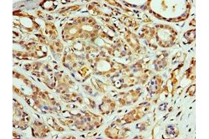 Immunohistochemistry of paraffin-embedded human breast cancer using ABIN7148496 at dilution of 1:100 (COPS4 抗体  (AA 1-310))