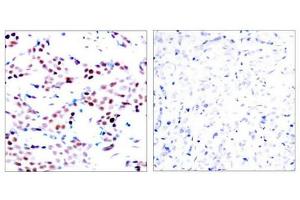 Immunohistochemical analysis of paraffin-embedded human breast carcinoma tissue using c-Jun(Phospho-Thr91) Antibody(left) or the same antibody preincubated with blocking peptide(right). (C-JUN 抗体  (pThr91))
