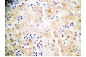 Human hepatocellular carcinoma tissue was stained by Rabbit Anti-FGF-21 (26-47) (H) (FGF21 抗体  (AA 26-47))