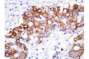Anti-GCLC antibody, IHC(P) IHC(P): Human Rectal Cancer Tissue