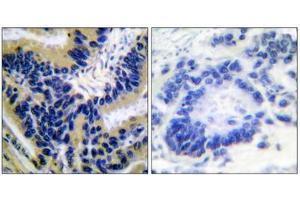 Immunohistochemical analysis of paraffin-embedded human lung carcinoma tissue, using Caspase 3 (cleaved-Asp175) antibody. (Caspase 3 抗体  (Cleaved-Asp175))