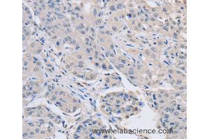 Immunohistochemistry of Human lung cancer using ABLIM1 Polyclonal Antibody at dilution of 1:30 (ABLIM1 抗体)