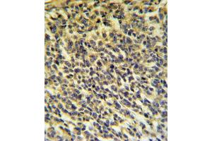 PLA2G6 Antibody (Center) (ABIN653895 and ABIN2843138) IHC analysis in formalin fixed and paraffin embedded testis carcinoma followed by peroxidase conjugation of the secondary antibody and DAB staining. (PLA2G6 抗体  (AA 551-580))
