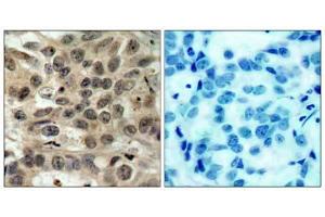 Immunohistochemical analysis of paraffin-embedded human breast carcinoma tissue, using cdc25C (Ab-216) antibody (E021145). (CDC25C 抗体)
