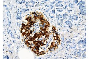 ABIN6259558 and ABIN6273929 at 1/100 staining Human pancreatic cancer and adjacent nomal tissues by IHC-P.