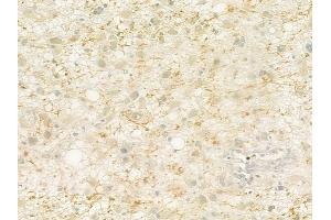 ABIN6260884 and ABIN6279308 at 1/100 staining human astrocytoma by IHC-P.