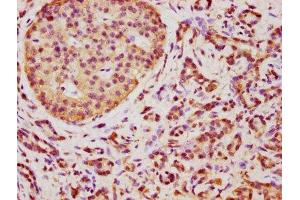 IHC image of ABIN7173067 diluted at 1:350 and staining in paraffin-embedded human pancreatic cancer performed on a Leica BondTM system. (TMEM14A 抗体  (AA 45-78))