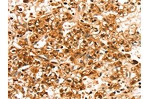 The image on the left is immunohistochemistry of paraffin-embedded Human prostate cancer tissue using ABIN7192494(SLC44A2 Antibody) at dilution 1/20, on the right is treated with synthetic peptide. (SLC44A2 抗体)