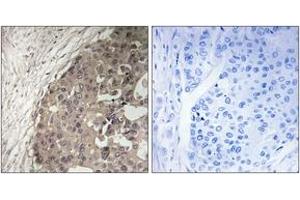 Immunohistochemistry analysis of paraffin-embedded human breast carcinoma tissue, using CSGALNACT1 Antibody. (CSGALNACT1 抗体  (AA 201-250))