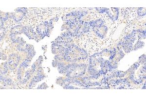 Detection of CAM in Human Colorectal cancer Tissue using Polyclonal Antibody to Calmodulin (CAM) (Calmodulin 1 抗体  (AA 2-149))