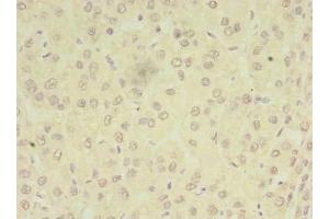 Immunohistochemistry of paraffin-embedded human liver cancer using ABIN7162969 at dilution of 1:100 (PEX11B 抗体  (AA 9-228))