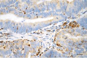 Immunohistochemistry was performed on paraffin-embedded human endometrial carcinoma using phospho-vimentin (Ser72) antibody (ABIN7800835), 1:100). (Recombinant Vimentin 抗体  (pSer72))