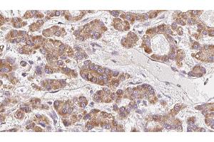 ABIN6272699 at 1/100 staining Human liver cancer tissue by IHC-P. (OR10H5 抗体  (C-Term))