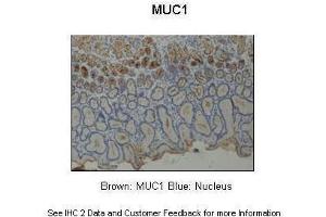 Sample Type :  Human stomach  Primary Antibody Dilution :  1:200  Secondary Antibody :  Anti-rabbit-HRP  Secondary Antibody Dilution :  1:1000  Color/Signal Descriptions :  Brown: MUC1 Blue: Nucleus  Gene Name :  MUC1  Submitted by :  Dr. (MUC1 抗体  (Middle Region))