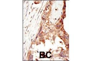 Formalin-fixed and paraffin-embedded human cancer tissue reacted with the primary antibody, which was peroxidase-conjugated to the secondary antibody, followed by DAB staining. (PRDM14 抗体  (N-Term))