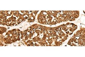 Immunohistochemistry of paraffin-embedded Human esophagus cancer tissue using CALML6 Polyclonal Antibody at dilution of 1:55(x200) (CALML6 抗体)