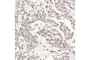 Immunohistochemistry of paraffin-embedded human breast cancer using [KO Validated] L3MBTL3 Rabbit pAb (ABIN6132145, ABIN6143061, ABIN6143062 and ABIN6223119) at dilution of 1:50 (40x lens). (L3MBTL3 抗体  (AA 1-230))