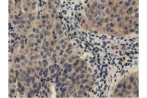 Immunohistochemical staining of paraffin-embedded Carcinoma of Human bladder tissue using anti-CBWD1 mouse monoclonal antibody. (CBWD1 抗体)