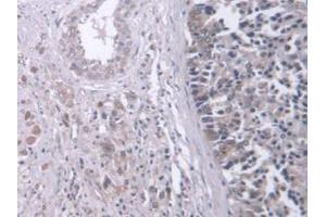 IHC-P analysis of Human Prostate Gland Cancer Tissue, with DAB staining. (Retinoic Acid Receptor beta 抗体  (AA 205-451))