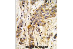 Formalin-fixed and paraffin-embedded human breast carcinoma tissue reacted with IARS2 antibody , which was peroxidase-conjugated to the secondary antibody, followed by DAB staining. (IARS2 抗体  (AA 600-628))