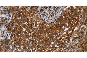 Immunohistochemistry of paraffin-embedded Human cervical cancer tissue using UHRF2 Polyclonal Antibody at dilution 1:40