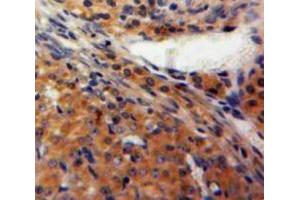 Used in DAB staining on fromalin fixed paraffin-embedded Ovary tissue (FBLN2 抗体  (AA 858-1069))
