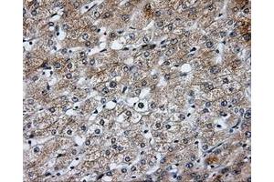 Immunohistochemical staining of paraffin-embedded Carcinoma of liver tissue using anti-SIL1 mouse monoclonal antibody. (SIL1 抗体)