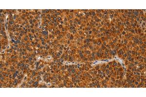 Immunohistochemistry of paraffin-embedded Human liver cancer tissue using IKZF3 Polyclonal Antibody at dilution 1:60 (IKZF3 抗体)