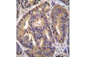 Immunohistochemistry analysis in formalin fixed and paraffin embedded human prostate carcinoma reacted with GTF2H2C Antibody (C-term) followed by peroxidase conjugation of the secondary antibody and DAB staining. (GTF2H2C 抗体  (C-Term))