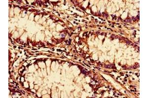 Immunohistochemistry of paraffin-embedded human colon cancer using ABIN7170624 at dilution of 1:100 (Pre-mRNA Branch Site Protein p14 (SF3B14) (AA 1-125) 抗体)